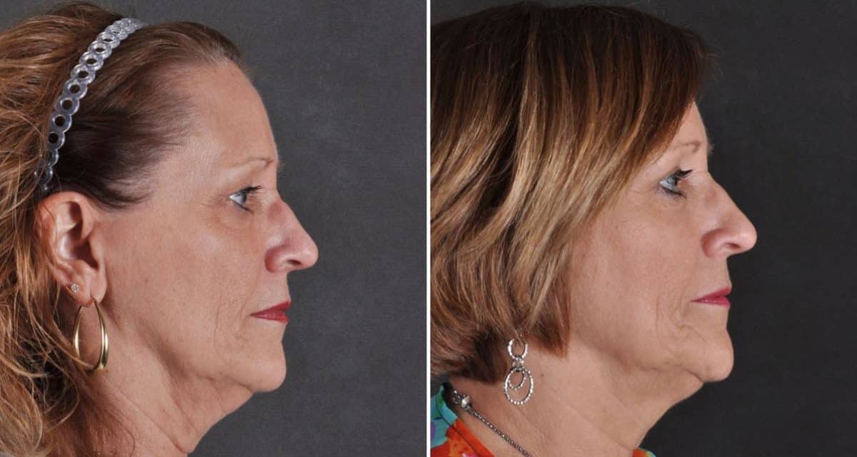 Blepharoplasty Before and After Photos in Omaha, NE, Case 9712