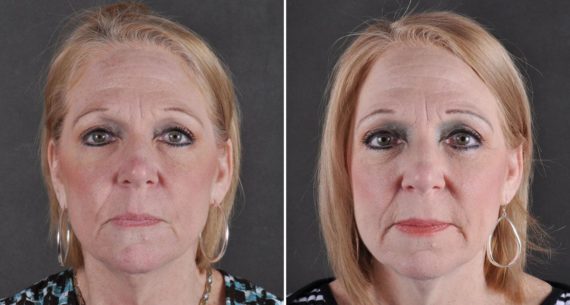 Blepharoplasty Before and After Photos in Omaha, NE, Case 9793