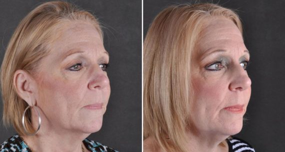 Blepharoplasty Before and After Photos in Omaha, NE, Case 9793