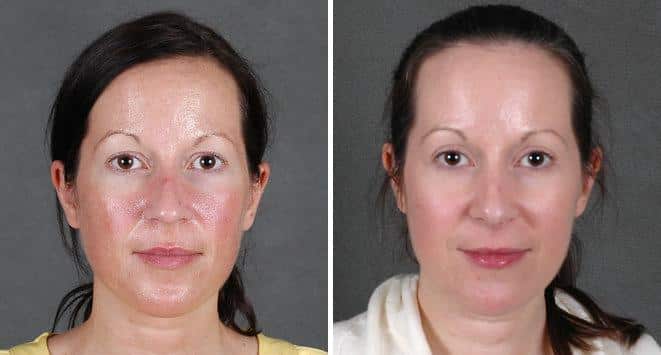 Blepharoplasty Before and After Photos in Omaha, NE, Case 5450