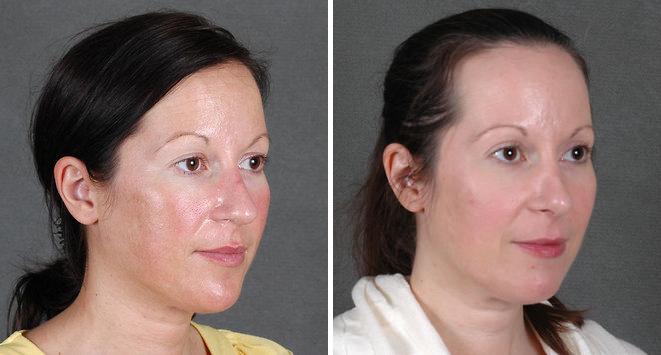 Blepharoplasty Before and After Photos in Omaha, NE, Case 5450