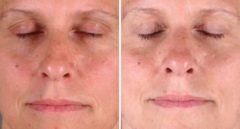 Blepharoplasty Before and After Photos in Omaha, NE, Case 5471