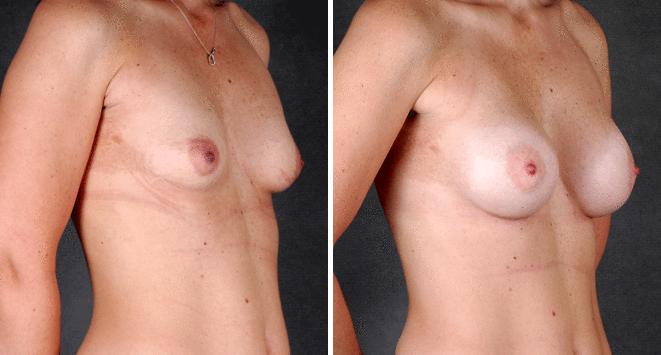 Breast Augmentation Before and After Photos in Omaha, NE, Case 5464