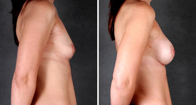 Breast Augmentation Before and After Photos in Omaha, NE, Case 5464