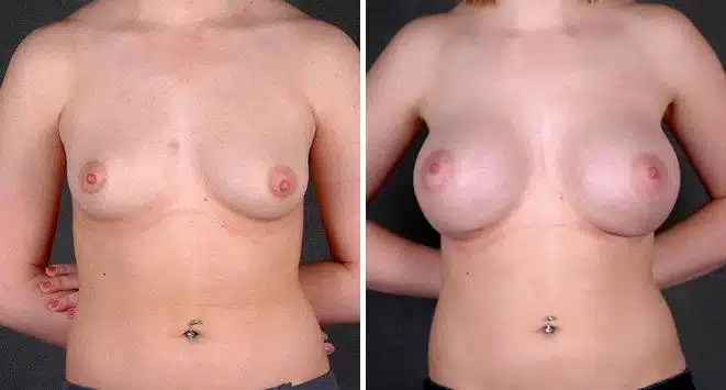 Breast Augmentation Before and After Photos in Omaha, NE, Case 5487