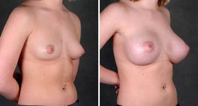 Breast Augmentation Before and After Photos in Omaha, NE, Case 5487