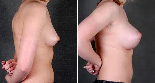 Breast Augmentation Before and After Photos in Omaha, NE, Case 5487