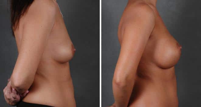 Breast Augmentation Before and After Photos in Omaha, NE, Case 5495