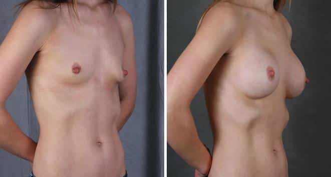 Breast Augmentation Before and After Photos in Omaha, NE, Case 5503