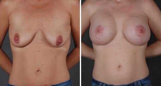 Breast Augmentation Before and After Photos in Omaha, NE, Case 5510