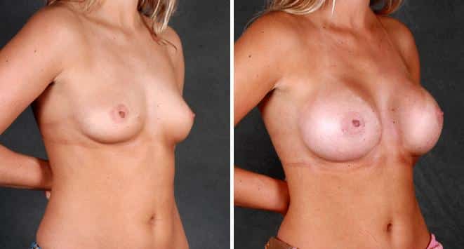 Breast Augmentation Before and After Photos in Omaha, NE, Case 5436