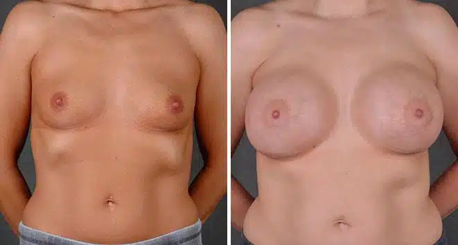 Breast Augmentation Before and After Photos in Omaha, NE, Case 7862