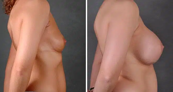 Breast Augmentation Before and After Photos in Omaha, NE, Case 7862