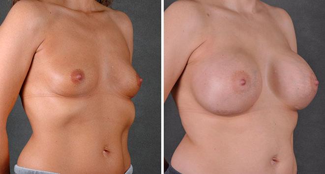 Breast Augmentation Before and After Photos in Omaha, NE, Case 7862