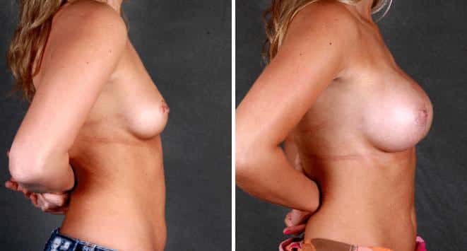 Breast Augmentation Before and After Photos in Omaha, NE, Case 5436