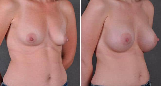 Breast Augmentation Before and After Photos in Omaha, NE, Case 7902