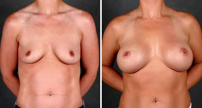 Breast Augmentation Before and After Photos in Omaha, NE, Case 5451