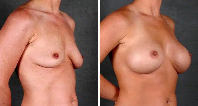 Breast Augmentation Before and After Photos in Omaha, NE, Case 5451