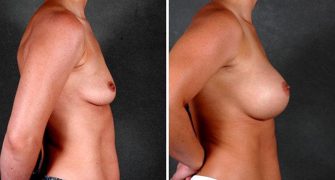 Breast Augmentation Before and After Photos in Omaha, NE, Case 5451