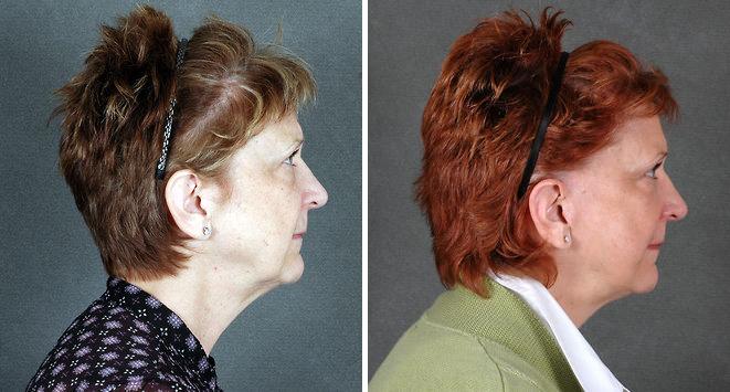Case 5534, Brow Lift Before and After Photos Brow Lift Before and After Photos in Omaha, NE, Case 5534