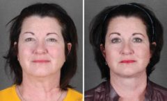 Brow Lift Before and After Photos in Omaha, NE, Case 5500