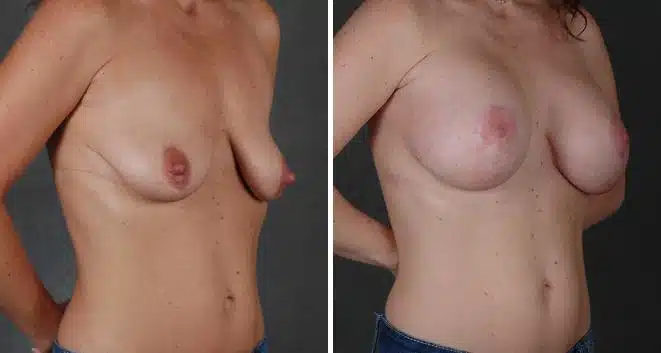 Breast Lift Before and After Photos in Omaha, NE, Case 5593