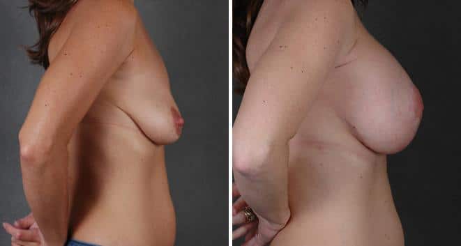 Breast Lift Before and After Photos in Omaha, NE, Case 5593