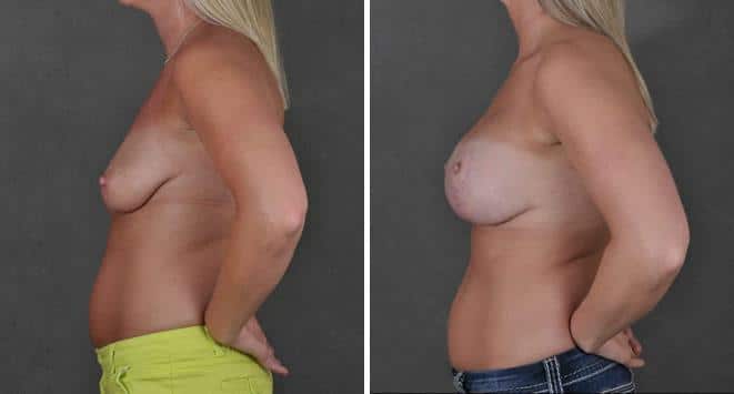 Breast Lift Before and After Photos in Omaha, NE, Case 5531