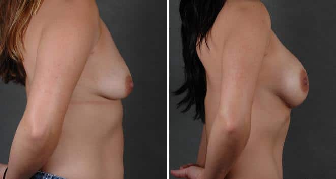 Breast Lift Before and After Photos in Omaha, NE, Case 5610