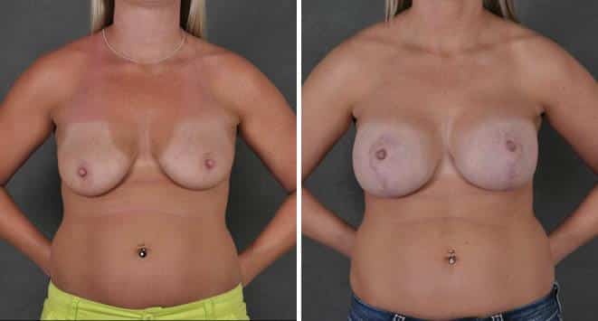 Breast Lift Before and After Photos in Omaha, NE, Case 5531