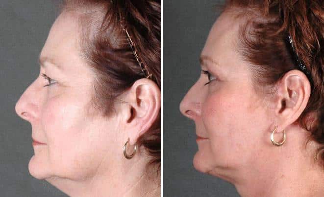 Facelift Before and After Photos in Omaha, NE, Case 5623