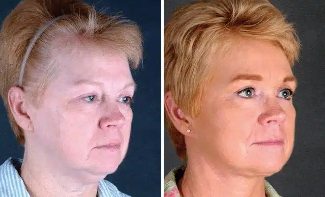 Facelift Before and After Photos in Omaha, NE, Case 5627