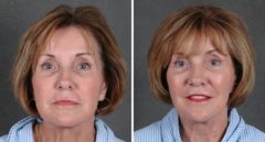 Facelift Before and After Photos in Omaha, NE, Case 5628