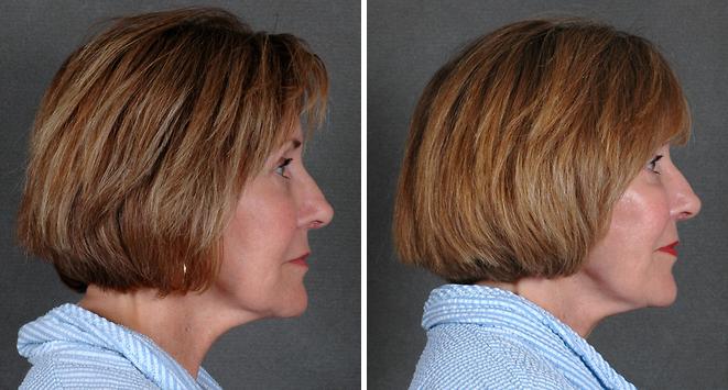 Facelift Before and After Photos in Omaha, NE, Case 5628