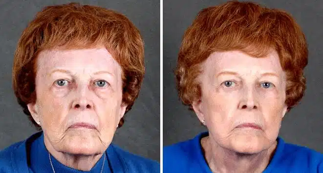 Facelift Before and After Photos in Omaha, NE, Case 5641