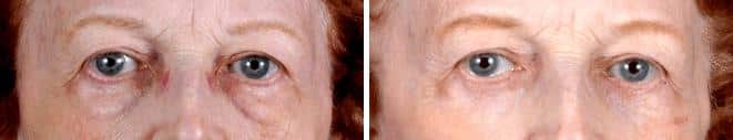 Facelift Before and After Photos in Omaha, NE, Case 5641