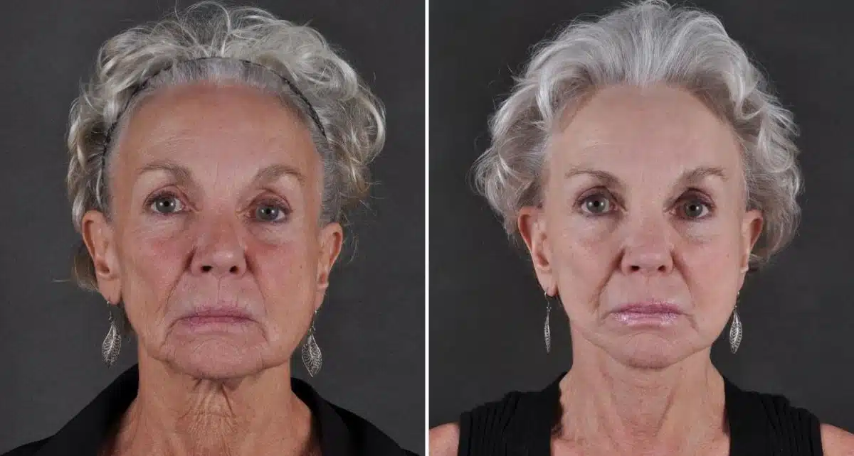 Facelift Before and After Photos in Omaha, NE, Case 8684