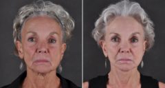 Facelift Before and After Photos in Omaha, NE, Case 8684