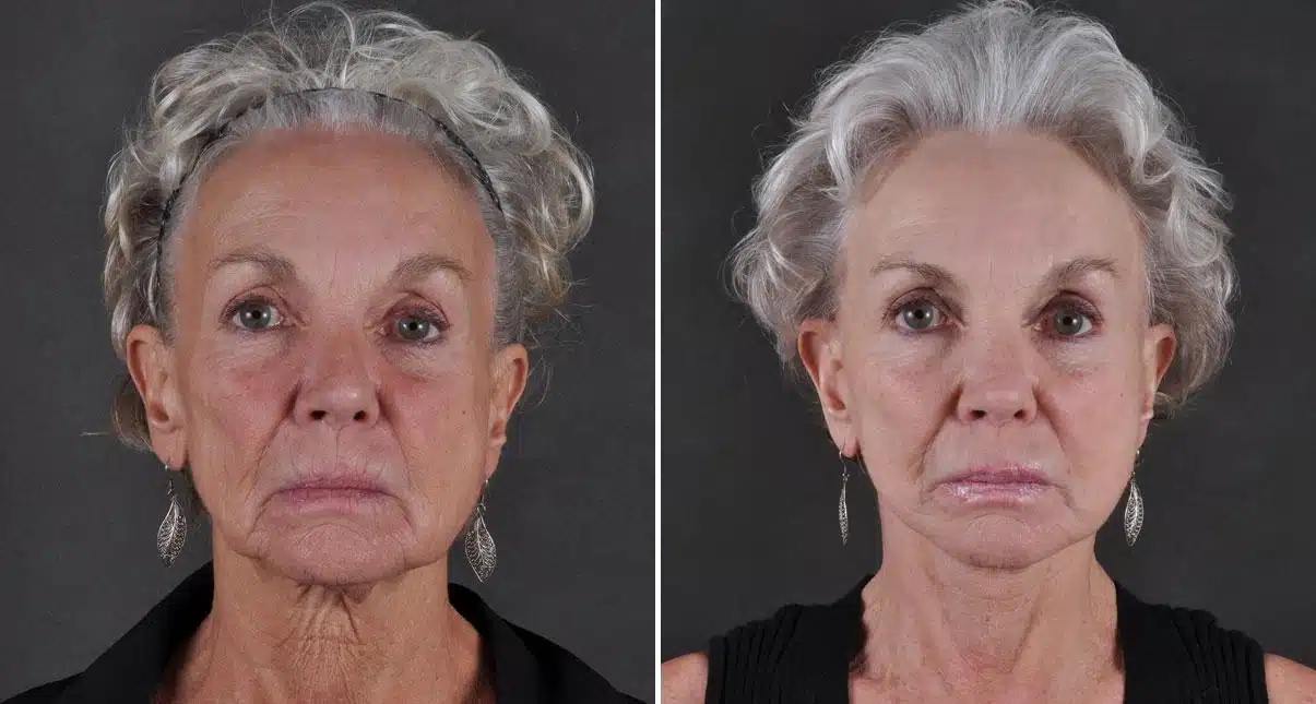 The Geographic Factor: How Location Affects Facelift Prices, Before and After Photos Facelift Before and After Photos in Omaha, NE, Case 8684