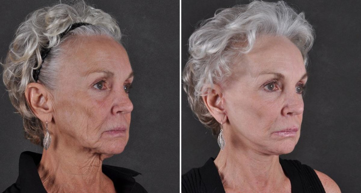 Facelift Before and After Photos in Omaha, NE, Case 8684