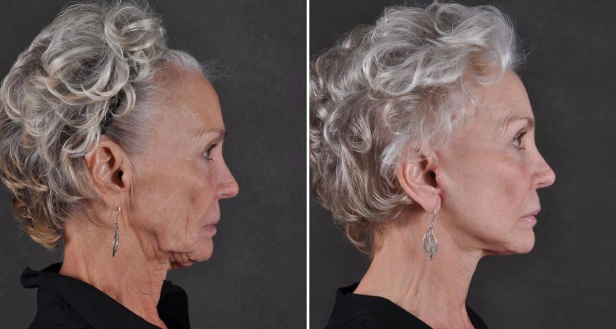 Facelift Before and After Photos in Omaha, NE, Case 8684