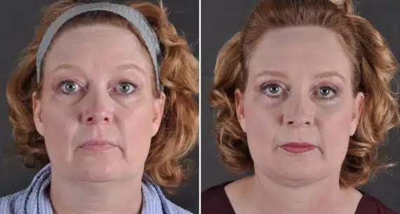 Facelift Before and After Photos in Omaha, NE, Case 8827