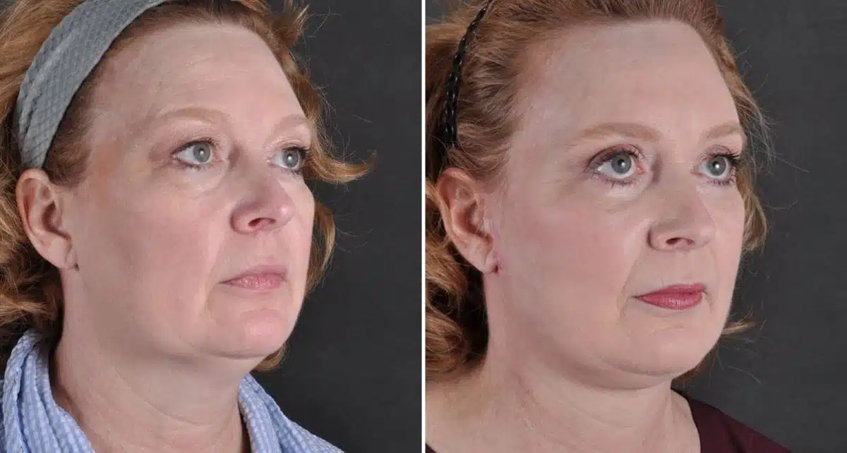 Facelift Before and After Photos in Omaha, NE, Case 8827