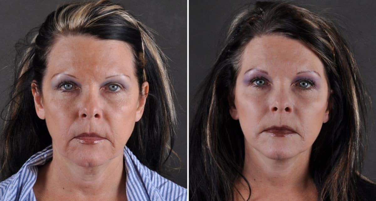 Facelift Before and After Photos in Omaha, NE, Case 8850