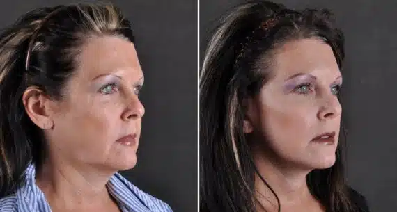 Facelift Before and After Photos in Omaha, NE, Case 8850