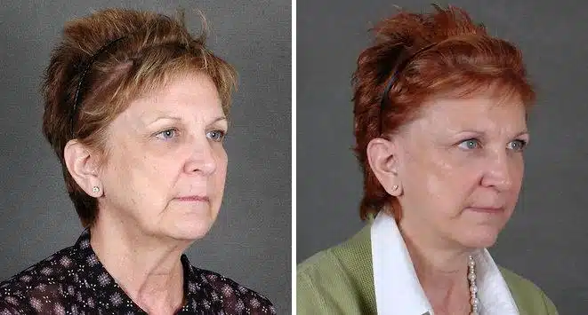 Facelift Before and After Photos in Omaha, NE, Case 5617