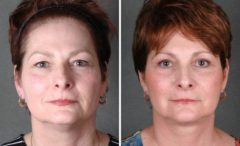 Facelift Before and After Photos in Omaha, NE, Case 5623