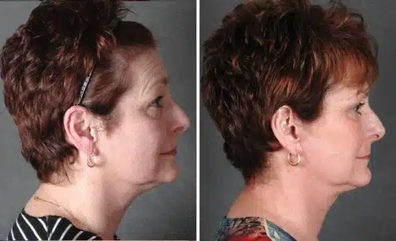 Facelift Before and After Photos in Omaha, NE, Case 5623