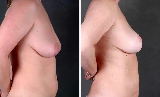 Breast Lift Before and After Photos in Omaha, NE, Case 5672