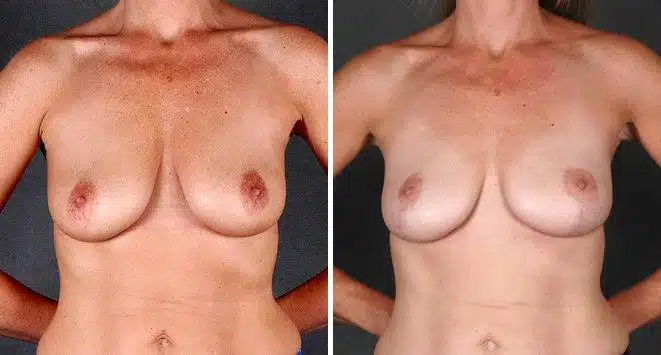 Breast Lift Before and After Photos in Omaha, NE, Case 5727